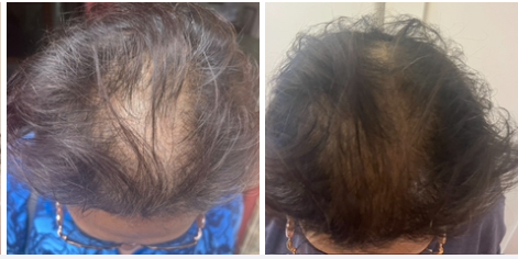 Hair Loss After Bariatric Surgery: A Natural Approach with Chinese Herbs to Regrow and Strengthen Hair